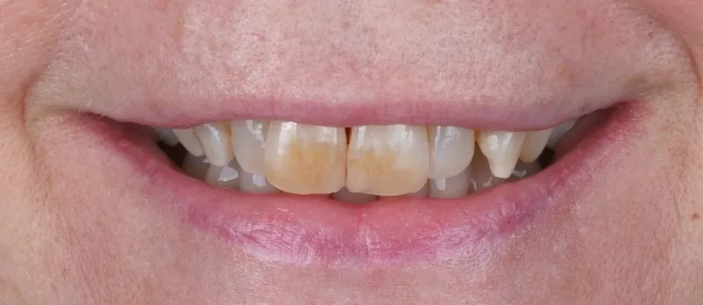 Before: stained front teeth
