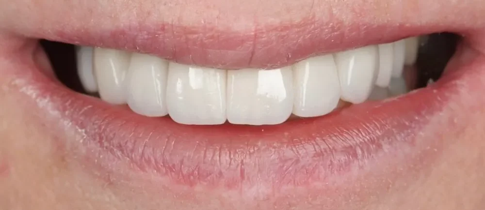 After: Halo Veneers full smile transformation