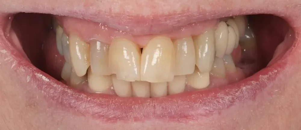 Before: Halo Veneers full smile transformation