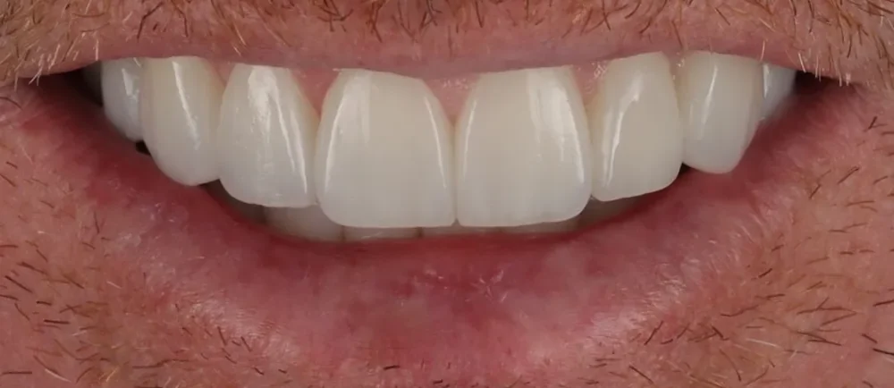 After: 8 ultra-thin Halo Veneers