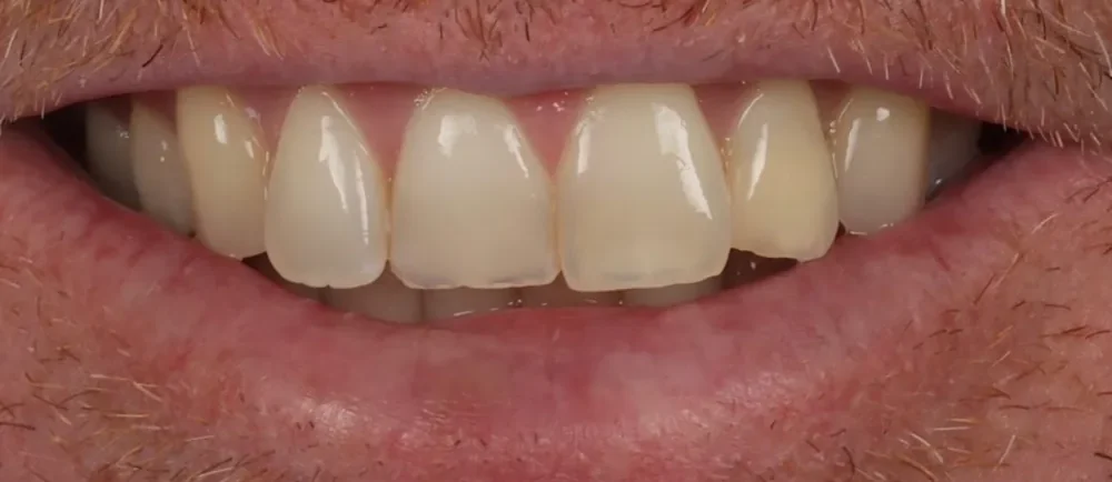 Before: uneven, yellow front teeth