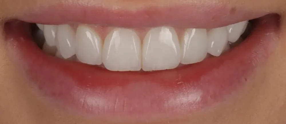 After: natural looking Halo Veneers
