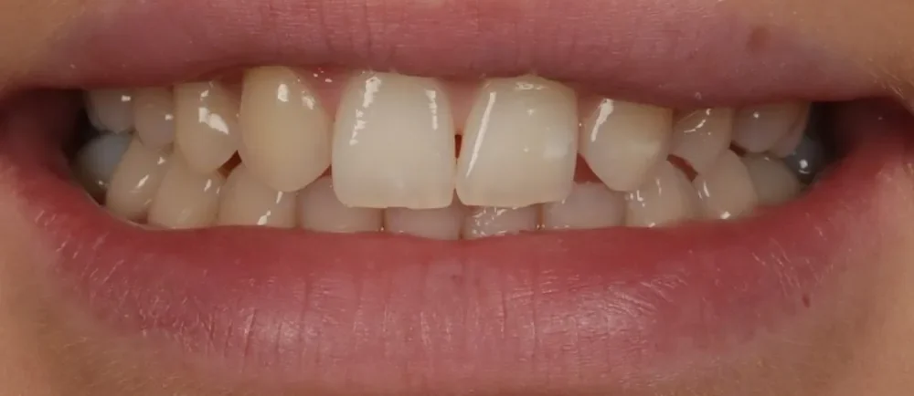 Before: uneven, crowded teeth