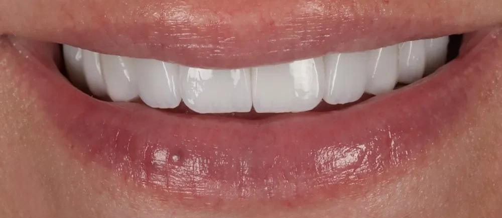 After: 10 Halo Veneers
