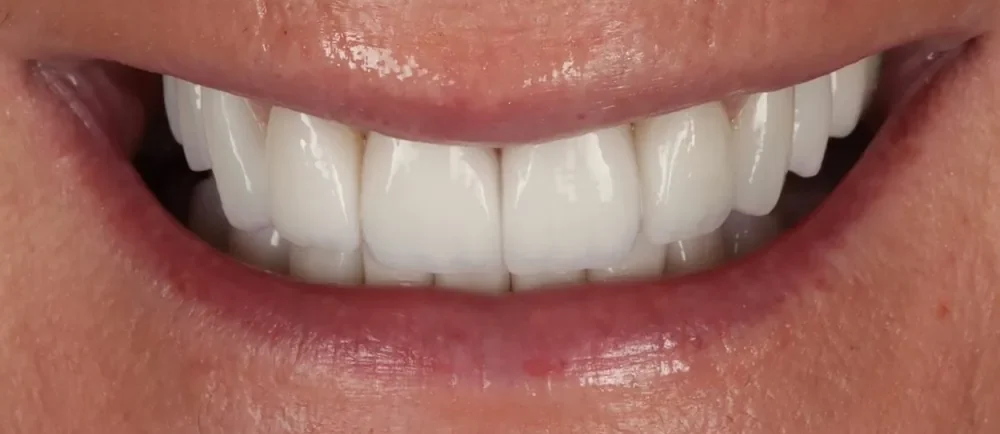 After: 20 Halo Veneers restoring worn teeth