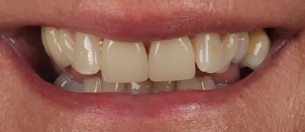 Before: worn and discoloured teeth
