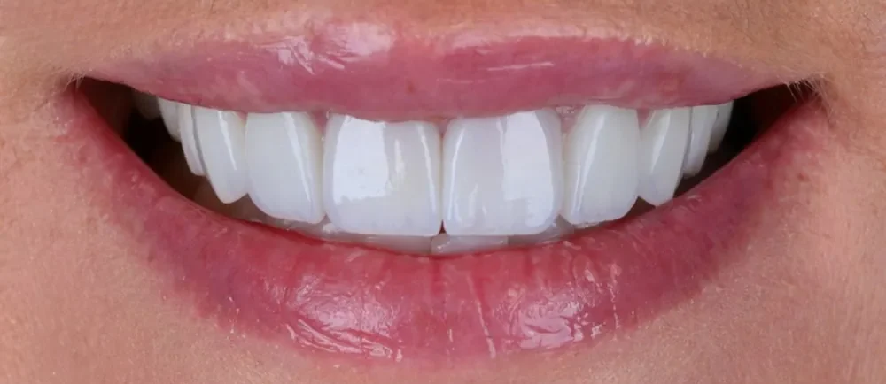 After: 8 Halo Veneers with a subtle finish