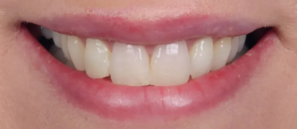 Before: natural teeth before veneers