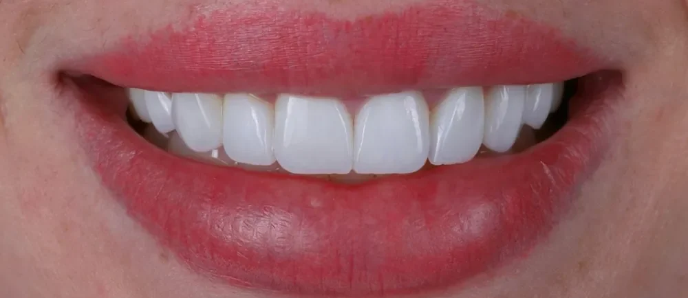 After: old bonding replaced with Halo Veneers