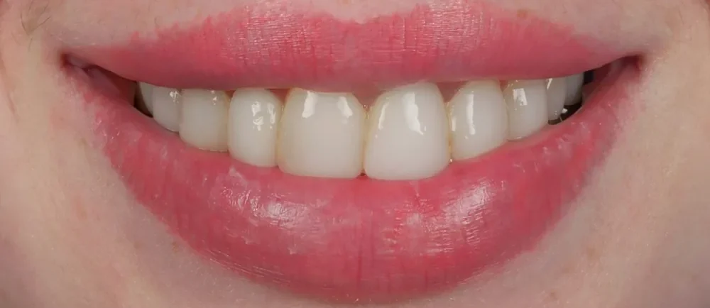 Before: old composite bonding