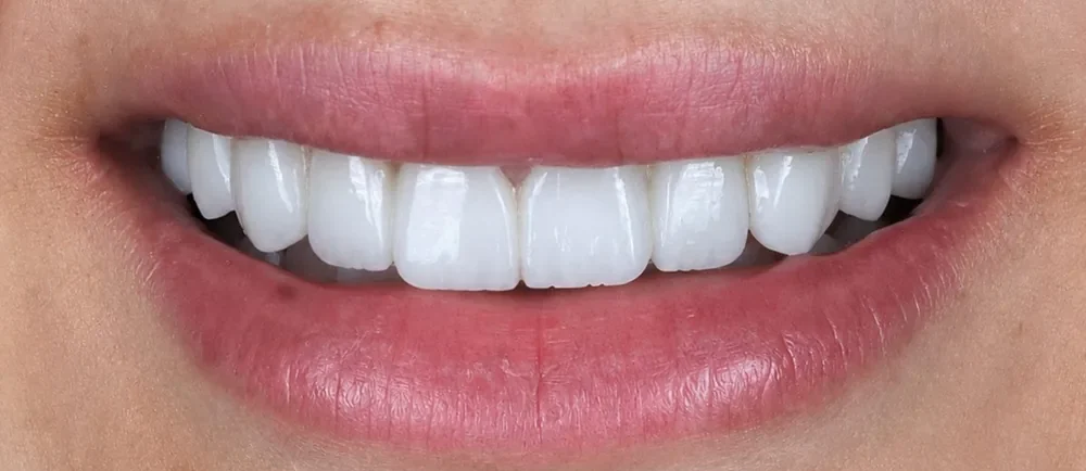 After: a full set of Halo Veneers