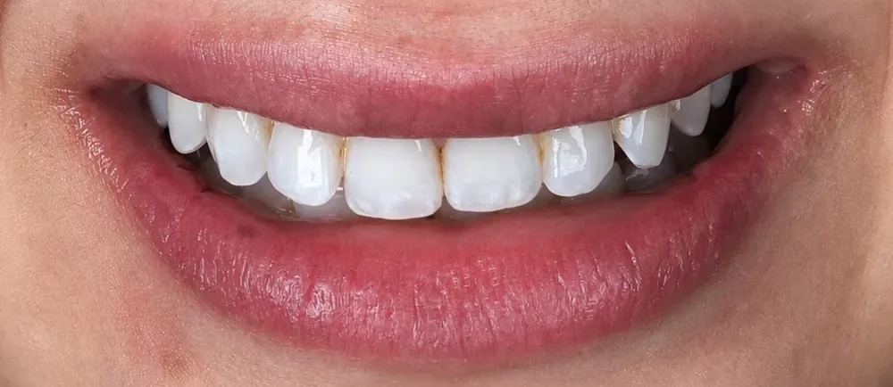 Before: small, uneven teeth
