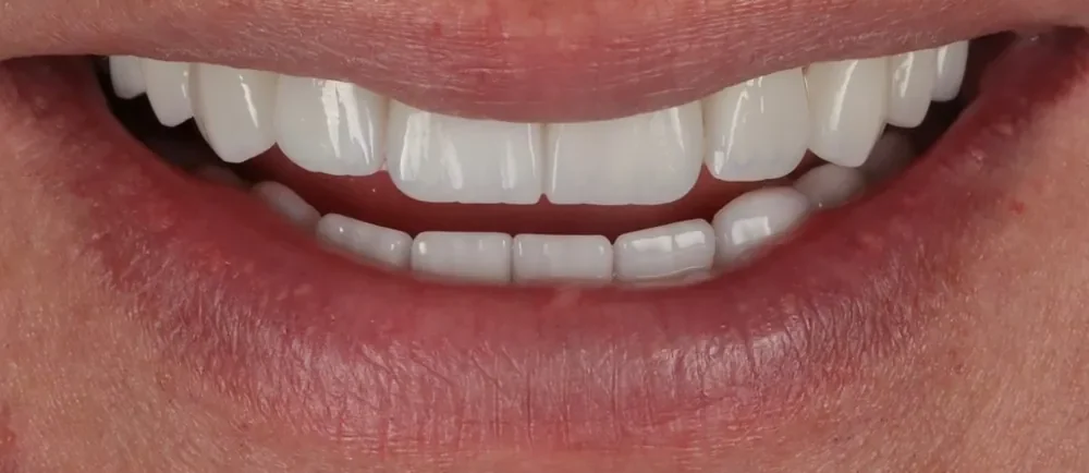 After: 20 Halo Veneers