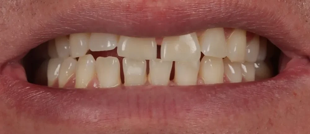 Before: worn, gappy teeth