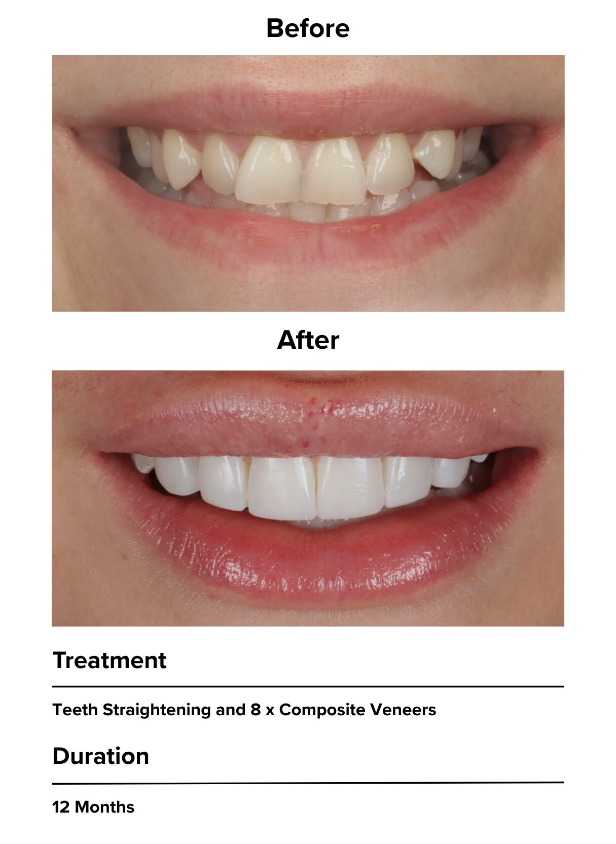 Invisalign after case