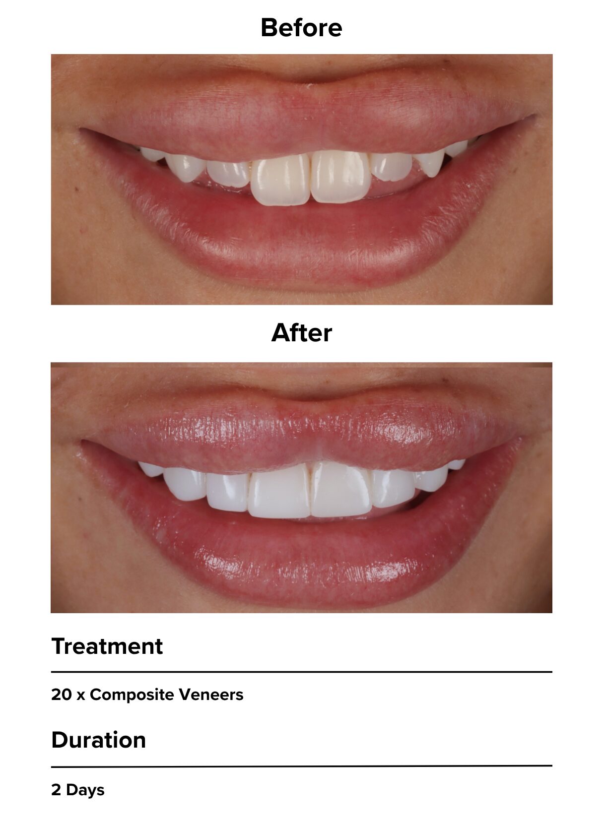 Natural-looking composite bonding